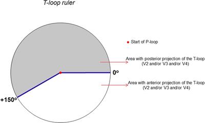 Electrovectorcardiographic study of left ventricular aneurysm in ischemic heart disease